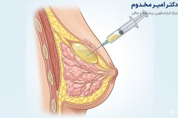 تجمع مایع