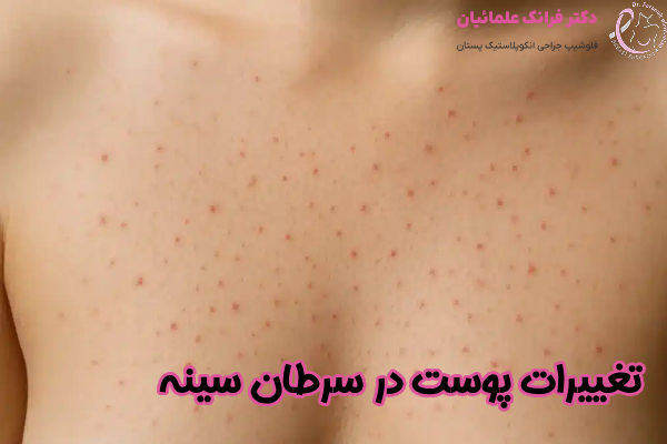 تغییر پوست در سرطان سینه